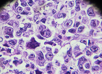 ¿Qué es una biopsia y cuándo se indica?